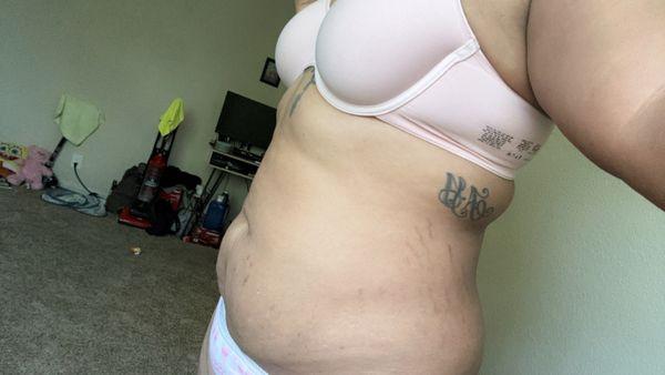 This is a month after the lipo injections side view