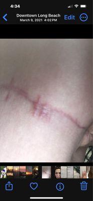 My incision (Terrible)