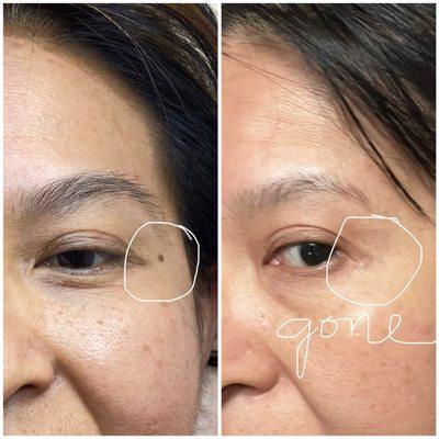 Age spot treatment