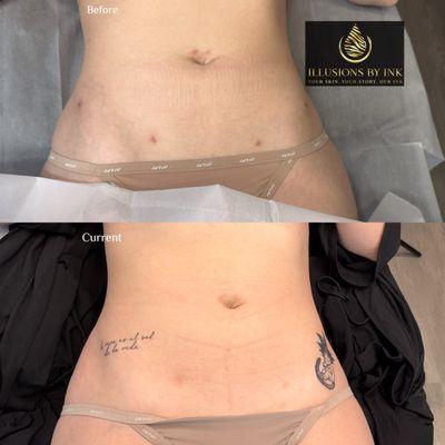 Lipo Suction Scar Concealment with Paramedical Tattoo