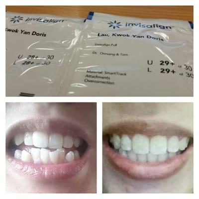 Got my wisdom teeth removed at the Perfect Smile and started the Invisalign treatmemt in feb,2014. Almost done! :)