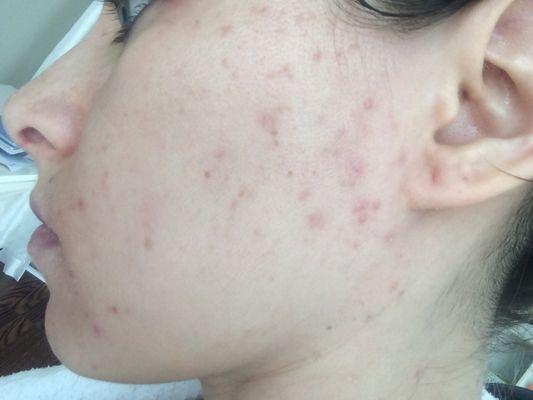 Acne continued to get worse very quickly....this is the point where I contacted Deborah...