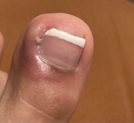 Infected hangnail