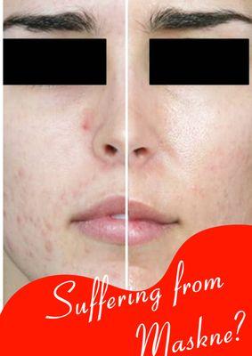 Suffering from Maskne? We can help clear your skin!  Call 703.539.8300 to book your consult & treatment.