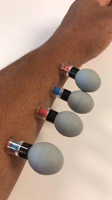 Magnet cupping to release trigger thumb