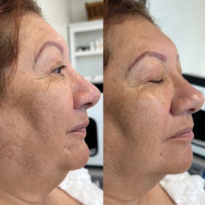 Experience a facial lifting treatment, totally painless and visible results each visit! This is before and after 1 session!