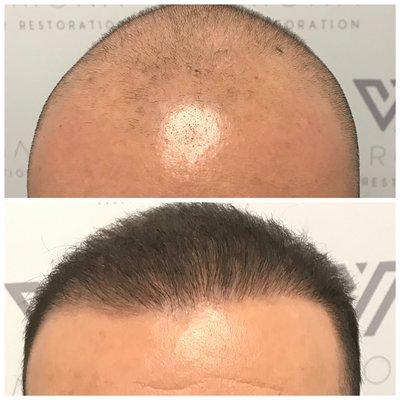 8 months after 2424 manual FUE grafts placed into the front half of the scalp. Patient also had light SMP procedure for a finishing touch.