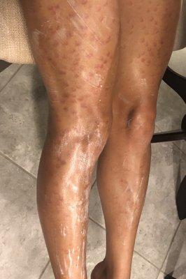 My legs the same day after laser hair removal