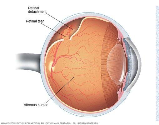 Retinal Detachment & Tear