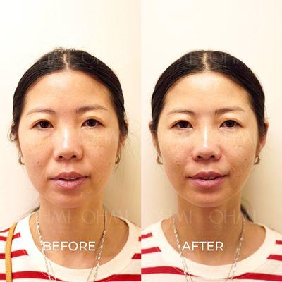 Dermal Filler Treatments
 Filler Injection 
 Full Face Treatment