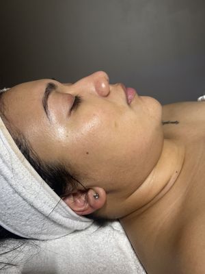 After results of a chemical peel