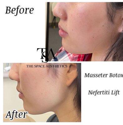 Facial balancing with Jawline slimming