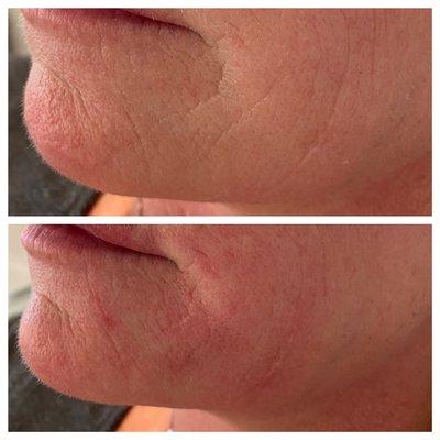 Immediately after skin booster for fine lines and wrinkles