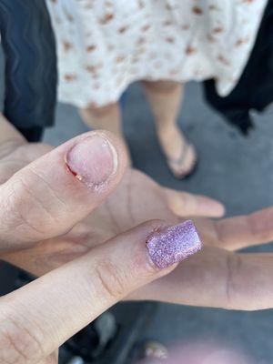 Cut her finger while doing acrylic, can clearly see damage to the nail bed after he ripped the acrylics off of her nails.