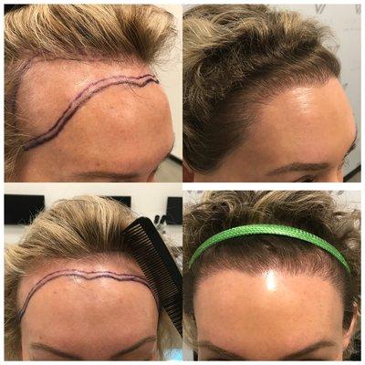 2500+ grafts hand placed into front temporal and hairline area