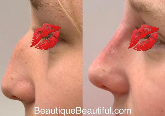 Non-surgical nose Job. 
Yes we can do that, only the best can do this. Within one hour, our beautiful patients leave loving their profile!