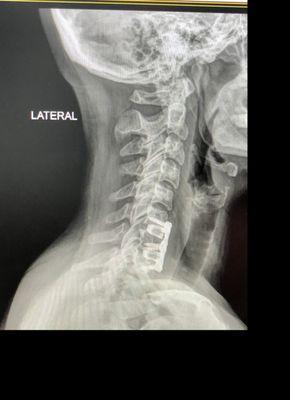 Cervical Spine Surgery - side view  08/09/2021