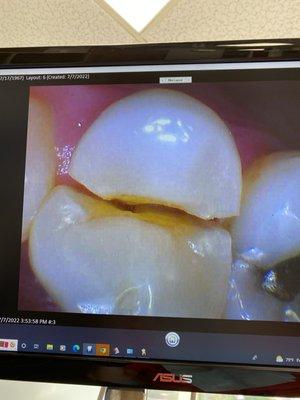 This is a view looking up at my tooth. It was cracked straight up the middle through the root. The dentist got the whole tooth out