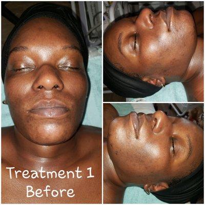 Before photo from a peel series to treat hyperpigmentation on Fitzpatrick VI skin.