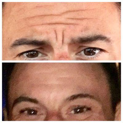 Once again AMAZING RESULTS! Went in on Wed for Botox btw the eyebrows and 5 days ltr...the pic speaks for itself.  Beyond my expectations.