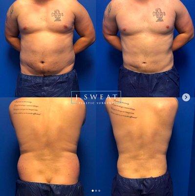 Men get lipo too!