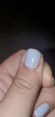 Another infection I have on the opposite hand from the nail tech digging into my nail bed using the cuticle cutters.