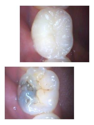 Porcelain Crowns Before and After