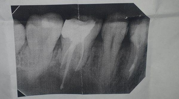 after the root canal: infection and protrudes past the apex of the root