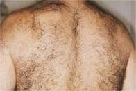 Before-Laser Hair Removal