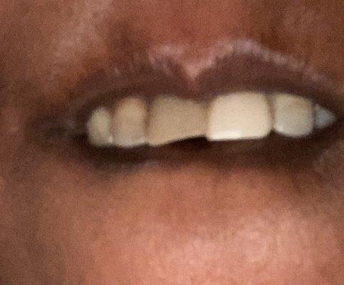 Front teeth crowns that need replaced and 2 different colors