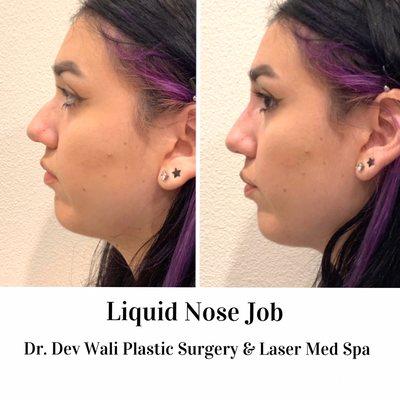 Non invasive liquid nose job