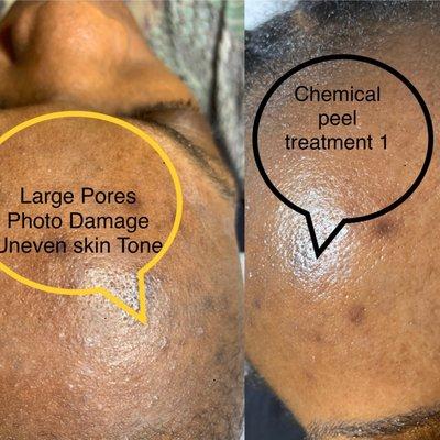 Chemical peel for acne and hyperpigmentation