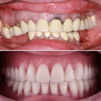 Implant Supported Dentures