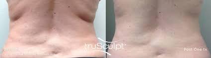 Remove Excess Fat with TruScupt 3D