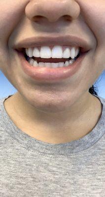 This is my after photo. I love Perfect Hollywood Smile!!