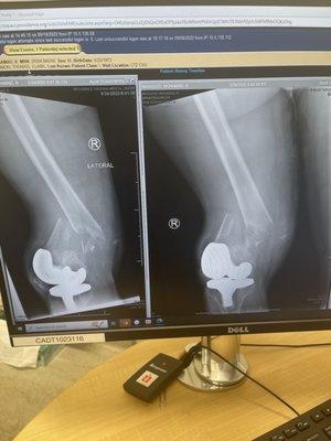 Broken femur