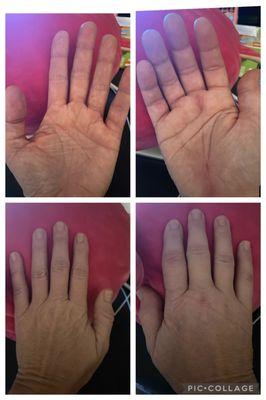 5 1/2 weeks post-op carpal tunnel & middle trigger finger release on right hand.