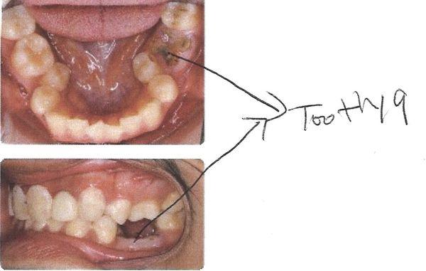 my tooth 19 Mr. Puschak made it missing 4.5 years after his root canal