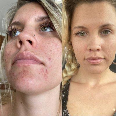 3 weeks after chemical peel, 2 weeks after acne facial + high frequency treatment