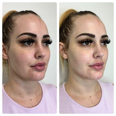 Before & After filler to the chin and marionette lines