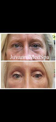 Undereye filler at juvanni