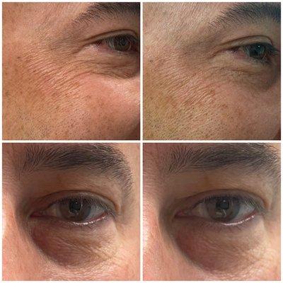 Jet plasma, single session and you can see that his skin texture has improved, multiple sessions are recommended for optimal results