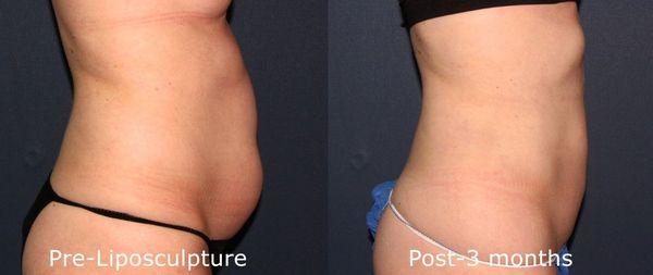 Post 3 months Coolsculpting results