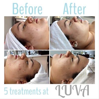 PCA Peel at LUVA and 5 treatments later my skin has never looked & felt better. I still have some to go, but it was so worth it!