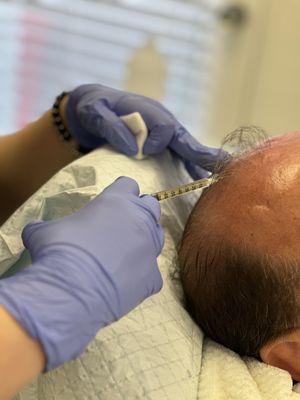 PRP for hair restoration