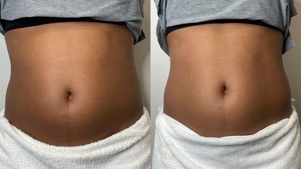 Body contour session one results before and right after.