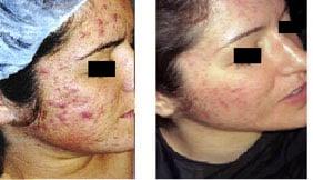 Acne treatments, Acne Peels, Extractions, Laser