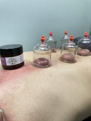 Cupping