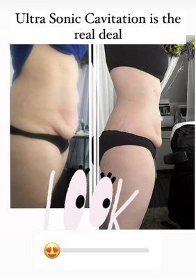 Body Sculpting  no down time no pain lose inches a d keep them off