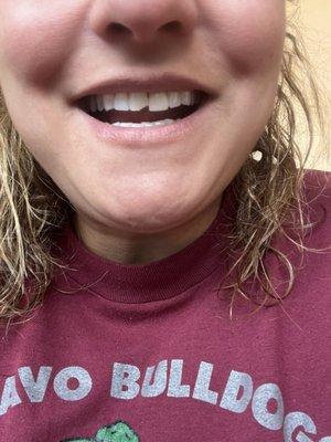 Before picture - chipped tooth